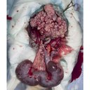 Metastasised uterine tumour