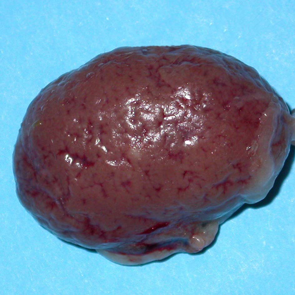 Scarred pitted kidney