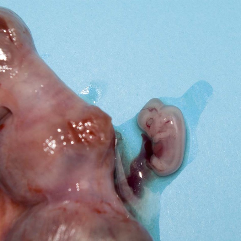 Embryo in viable foetal unit